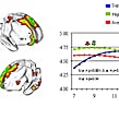 cortex maturation: lag, span and thickness: ADHD, Schizophrenia, autism , IQ